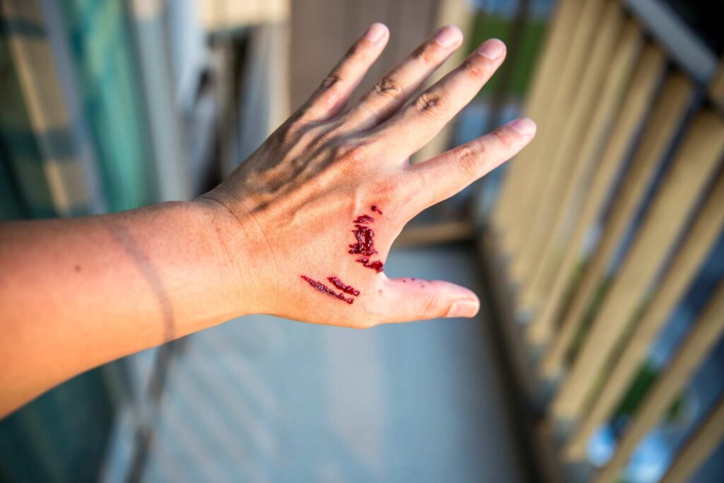 Dog Bites